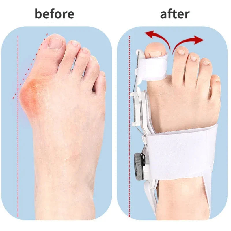 Bunion Corrector Unisex Hallux Valgus Toe Separator Straightener